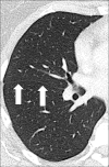 Fissure: Transverse CT image of the right lung shows major fissure
(arrows). 