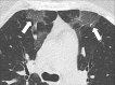 Focal ground-glass opacities: Transverse CT image of the upper lobes shows
subtle, focal ground-glass opacities in the right and left lungs (arrows). 