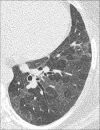 Mosaic attenuation: Transverse CT image of the left lung shows geographic
regions of normal and abnormally increased attenuation. 