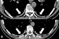 Plaque: (A, B) Transverse CT images of the lower thorax show partially
calcified pleural plaques (arrows). 