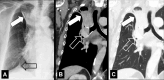 Atelectasis: (A) Frontal chest radiograph and (B, C) coronal CT image
reconstructions in mediastinal and lung windows show right upper lobe
atelectasis (solid arrow) caused by central tumor (open arrow). Note presence of
juxtaphrenic peak in A (open arrow). 