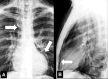 Pneumomediastinum: (A) Frontal and (B) lateral chest radiographs show
mediastinal air collection (arrows). 