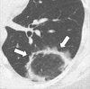 Atoll sign: Transverse CT image of the left lower lobe shows focal
ground-glass opacities surrounded by a thin ring of consolidation (arrows). 