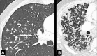Nodular: Transverse CT images of the right lung of two different patients
show (A) moderate and (B) extensive nodular pattern. 