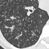 Tree-in-bud: Transverse CT image of the right lower lobe shows multifocal
tree-in-bud with branching opacities. 