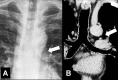 Aortopulmonary window: (A) Frontal chest radiograph and (B) coronal CT
image reconstruction in the same patient show aortopulmonary window (arrow). 