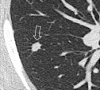 Nodule: Transverse CT image of the right lung shows a mildly spiculated
nodule (arrow). 