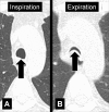 Excessive dynamic airway collapse: Transverse CT images at the level of
the aortic arch in (A) inspiration and (B) expiration. Expiration causes an
excessive invagination of the posterior tracheal wall (arrow). 
