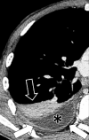 Empyema: Transverse contrast-enhanced CT image of the right lower lobe
shows empyema (asterisk) surrounded by thickened and enhancing pleura (solid
arrows), with adjacent atelectasis (open arrow). 