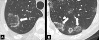 Atoll sign: Transverse CT images of the (A) right and (B) left lower lobes
in two different patients show focal ground-glass opacities surrounded by a thin
ring of consolidation (arrows). 