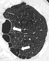 Paraseptal: Transverse CT image of the left upper lobe shows paraseptal
emphysema (arrows). Mild centrilobular emphysema is also present. 