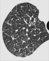 Interstitial: Transverse CT image of the right upper lobe shows
interstitial pattern caused by thickened interlobular septa. 