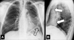 Atelectasis: (A) Frontal and (B) lateral radiograph shows complete left
upper lobe and lingula atelectasis (solid arrows). Note presence of juxtaphrenic
peak (open arrow). 