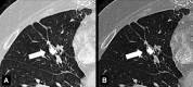 Broncholith: Transverse CT image through the right lung (A, lung window;
B, bone window) show broncholith (arrow). 