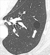 Pneumatocele: Transverse CT image through the left lung shows well-defined
pneumatocele (arrow). 