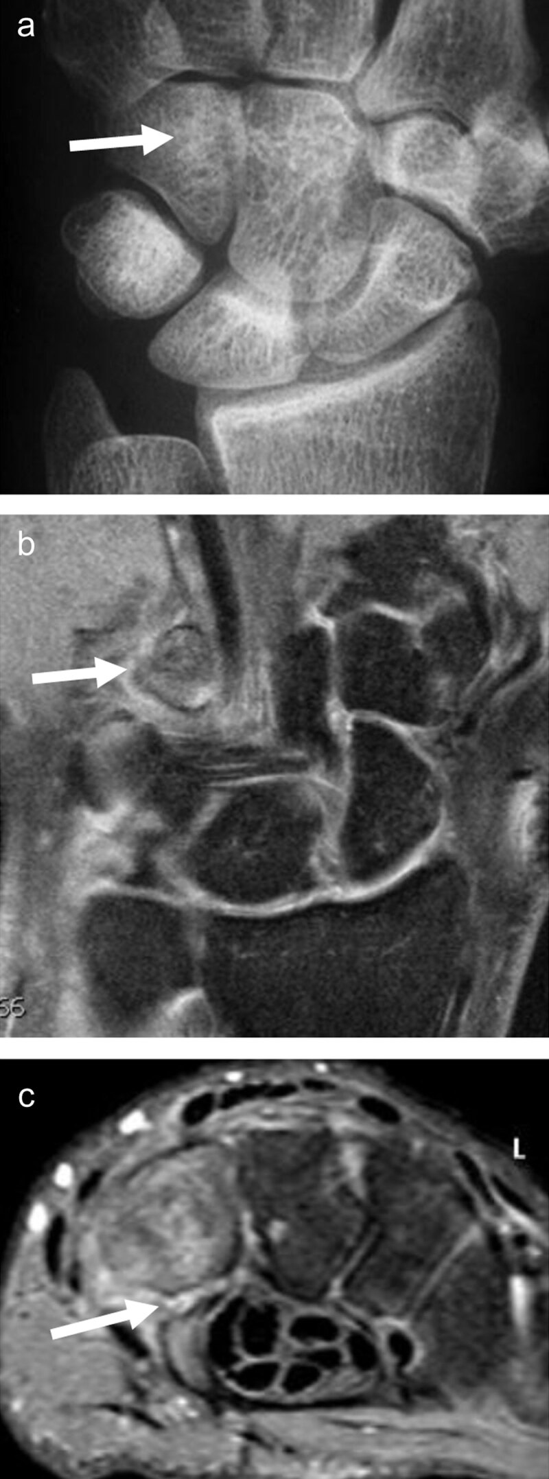 Fracture of the hook of the hamatum, easily missed on conventional radiographs and on fat-saturated MR images