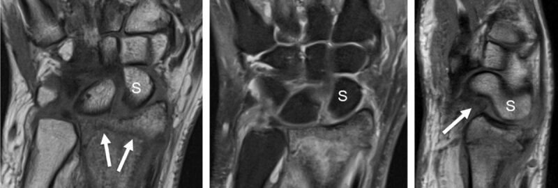 Distal radius fracture with associated intrinsic scapholunate (SL) and extrinsic palmar radiocarpal ligament rupture (RSC, radioscaphocapitate) detected by MRI