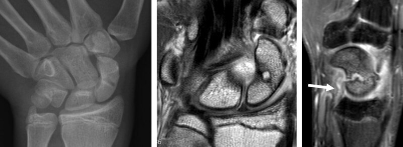 Evolution of scaphoid fracture with pseudarthrosis in a 17-year-old male