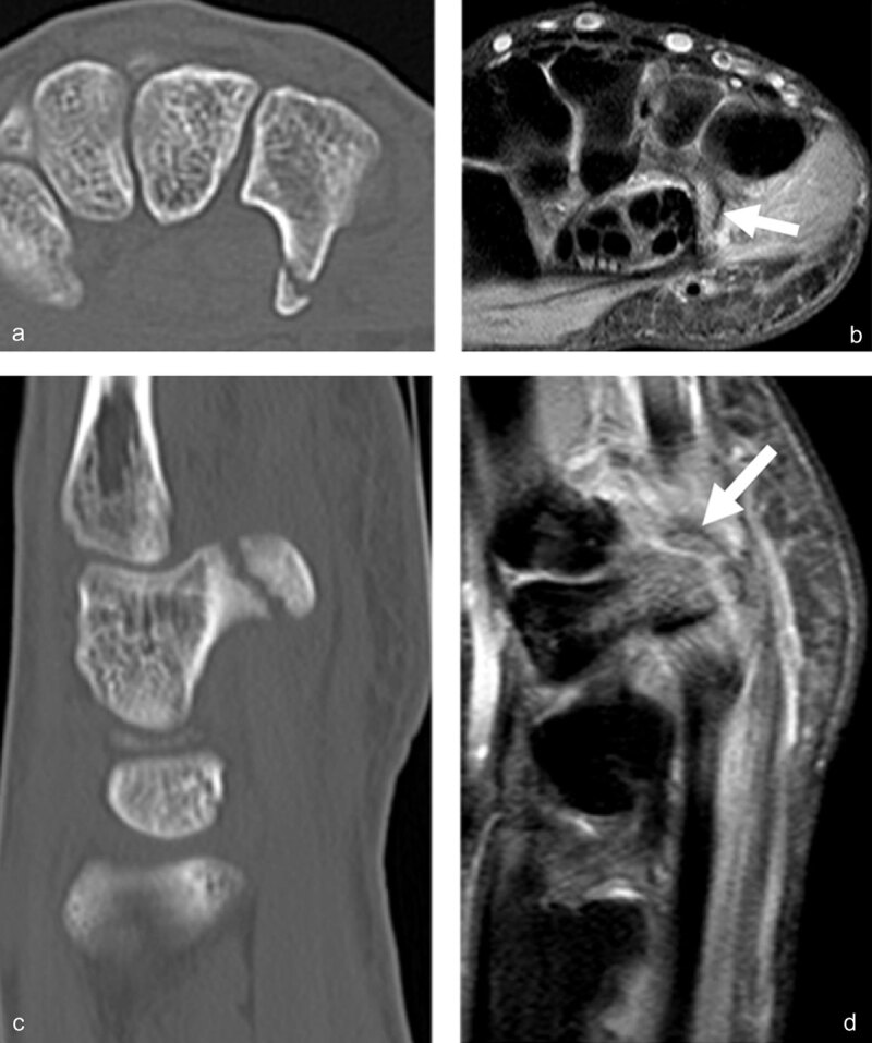 Another case of direct compression of the hook of the hamate