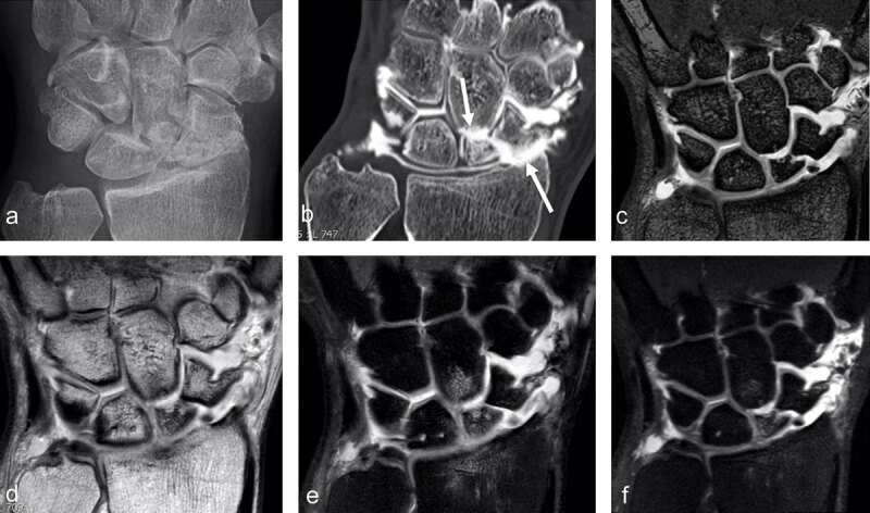 SNAC 2 wrist after scaphoid fracture with nonunion in a 41-year-old man