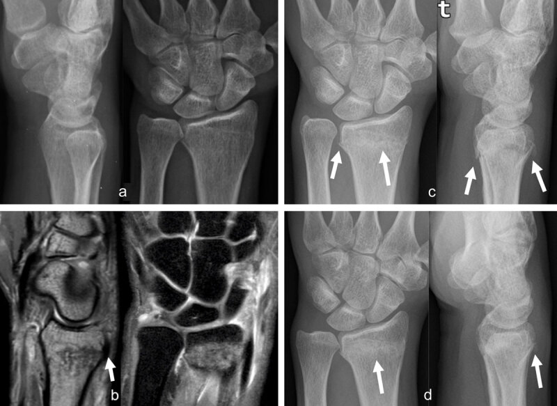 Occult radius fracture detected by MRI