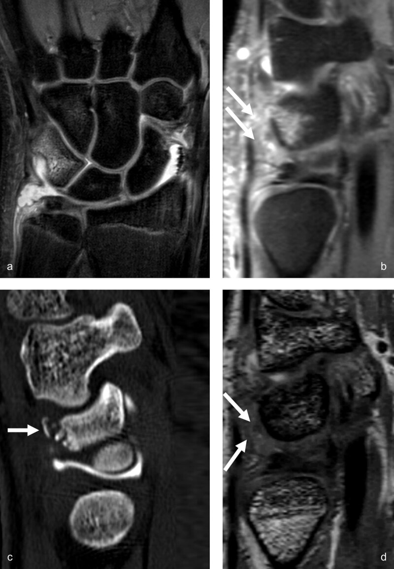 Triquetrum occult fracture with synovitis in the prestyloid recess and traumatic bone avulsion with subacute edematous infiltration of the dorsal capsular ligaments