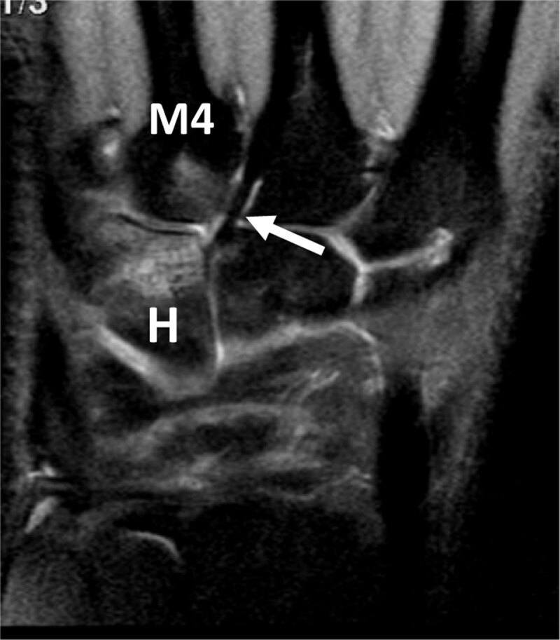 Hamate BME and associated BME of the fourth metacarpal base in an overused pianist hand