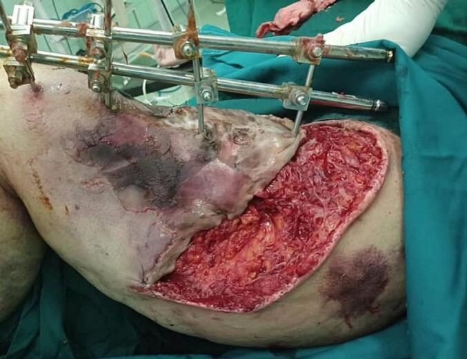 the-clasp-and-rubber-bands-technique-to-close-large-skin-soft-tissue