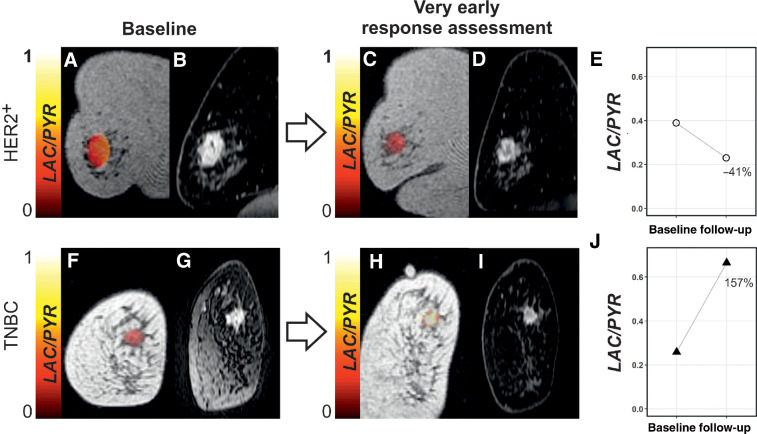 Figure 1. Changes in LAC/PYR between baseline and very early response assessment in a responder and nonresponder. A, C, F, and H, Coronal T1-weighted 3D spoiled gradient echo (SPGR) images with LAC/PYR map overlaid on the breast tumor. B, D, G, and I, Coronal reformatted DCE images obtained 150 seconds after intravenous injection of a gadolinium-based contrast agent. A patient with HER2+ breast cancer was imaged at baseline (A and B) and for ultra-early response assessment (C and D) following standard-of-care treatment and showed a decrease in LAC/PYR of 41% (E), indicating nonresponse. At surgery, non-pCR with residual invasive cancer was identified. Another patient with TNBC was imaged at baseline (F and G) and for ultra-early response assessment (H and I) following treatment with chemotherapy and a PARP inhibitor and showed an increase in LAC/PYR of 157% (J), indicating response. At surgery, pCR without residual invasive breast cancer was found. HER2+, HER2/neu positive.