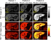 The field strength dependence of R2*-based liver iron
concentration (LIC) mapping is removed after conversion of R2* to LIC
maps. Shown are R2* and LIC maps from three patients imaged at 1.5 T
and 3.0 T on the same day. R2-based LIC values are also shown
(top).