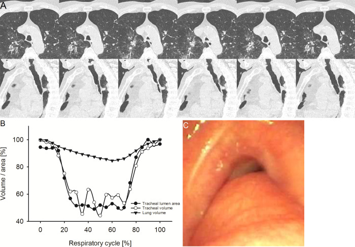 Representative example of circumferential-type tracheobronchomalacia (TBM). (A) Image from four-dimensional (4D) CT (noncontrast, lung window) in a 72-year-old male patient with circumferential-type TBM at the level of maximum observed tracheal collapsibility at representative selected time points of the respiratory cycle. The upper row shows axial view, the lower row sagittal view. The axial view demonstrates the circular collapse of the trachea because of cartilaginous malacia. (B) Graph shows the changes of minimal tracheal lumen area, tracheal volume, and lung volume in the same patient over the respiratory cycle with 21 time points in 5%-wide steps at 4D CT. (C) Image from correlated bronchoscopy.