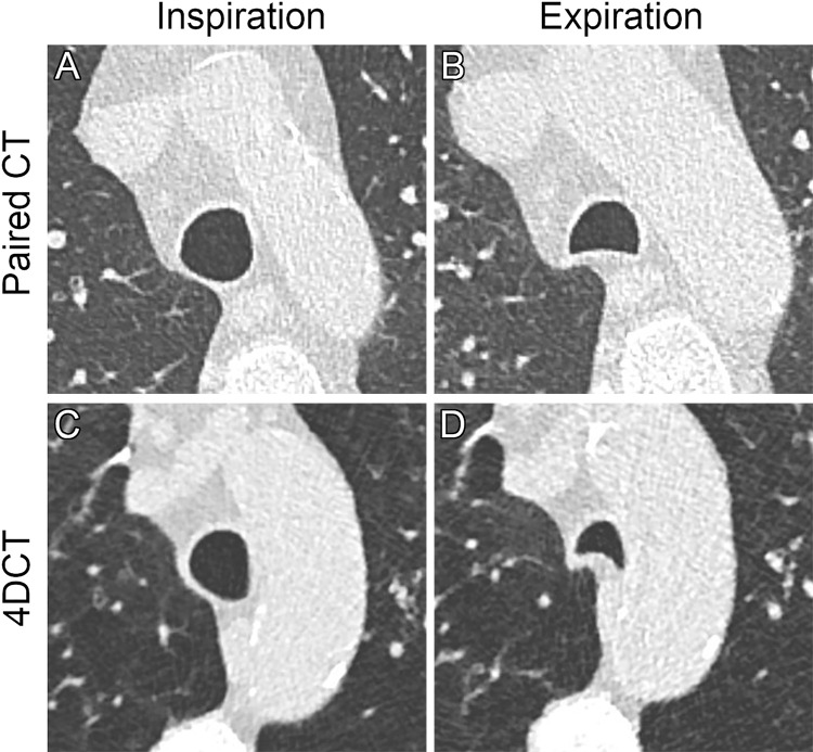 Low concordance of paired inspiratory-expiratory CT with four-dimensional (4D) CT. The top row represents paired inspiratory-expiratory CT (noncontrast, lung window) in (A) inspiratory and (B) expiratory breath hold in axial plane in a 77-year-old male patient. The bottom row shows the same patient under shallow breathing at 4D CT (noncontrast, lung window) in (C) maximum inspiration and (D) end expiration in axial plane. Note that the tracheal collapsibility was less than 50% at paired inspiratory-expiratory CT but 50% or greater at 4D CT. The level of strongest collapse varied slightly between paired CT and 4D CT.