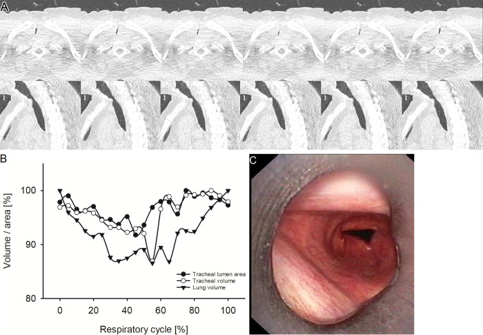 Representative example of fixed tracheal stenosis. (A) Images from four-dimensional (4D) CT (noncontrast, lung window) in a 53-year-old female patient with fixed tracheal stenosis at the level of maximum observed tracheal narrowing at representative selected time points of the respiratory cycle. The upper row shows axial view, the lower row sagittal view. No dynamic changes were observed. (B) Graph shows the changes of minimal tracheal lumen area, tracheal volume, and lung volume of the same patient over the respiratory cycle with 21 time points in 5%-wide steps at 4D CT. (C) Image from correlated bronchoscopy.