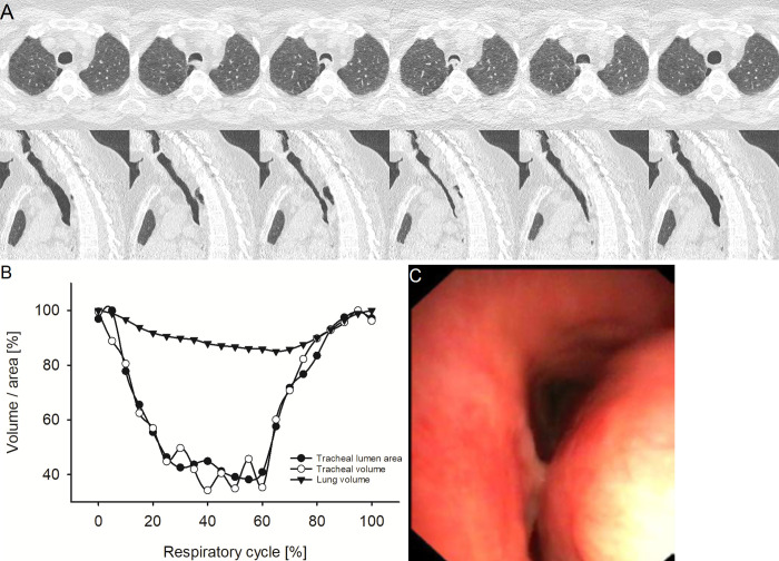 Representative example of excessive dynamic airway collapse (EDAC). (A) Images from four-dimensional (4D) CT (noncontrast, lung window) in a 51-year-old female patient with EDAC at the level of maximum observed tracheal collapsibility at representative selected time points of the respiratory cycle. The upper row shows axial view, the lower row sagittal view. The axial view demonstrates the inward bowing of the posterior membrane while the cartilage retains its normal shape. (B) Graph shows the changes of minimal tracheal lumen area, tracheal volume, and lung volume of the same patient over the respiratory cycle with 21 time points in 5%-wide steps at 4D CT. (C) Image from correlated bronchoscopy.