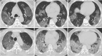 A-C, Noncontrast chest CT images in a 56-year-old man with severe COVID-19 pneumonia. CT images show multiple ground-glass opacities in multiple lung segments, and the CT-SS is 28. D-F, Noncontrast chest CT images in a 69-year-old man with severe COVID-19 pneumonia. CT images show multiple ground-glass opacities and septal thickening; the imaging manifestation is the so-called white lungs; the CT-SS is 35.