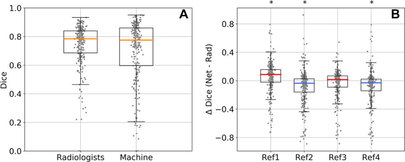 Network (net) and radiologist (rad) performance on the test set of 250 malignant cases. (A) Distribution of Dice scores in 250 test cases averaged across four reference segmentations. (B) Difference in Dice score between the network and each radiologist (Δ Dice) for each of the four reference (ref) segmentations (ref1, ref2, ref3, and ref4). The median Dice value was higher for the network for ref1 and ref3 (red median Δ Dice) and higher for the radiologist for ref2 and ref4 (blue median Δ Dice). Box plots show median (orange, red, or blue lines), quartiles (box), and 1.5 interquartile range (whiskers). *P < .001 (Wilcoxon signed rank test).