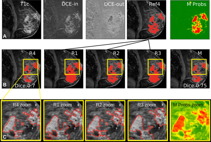 Manual and automated segmentations of breast cancer. (A) Inputs to the model consisting of the first postcontrast image (T1c), postcontrast minus precontrast image (T1) (DCE-in), and washout (DCE-out), with an independent reference for radiologist 4 (R4) made from the intersection of radiologists 1–3 (R1–R3 [Ref4]) and the network output (M Probs) indicating probability that a voxel is cancer (green = low; red = high). (B) Example segmentation from all four radiologists (R1–R4) for a given section, and the model segmentation created by thresholding probabilities (M). Dice scores for R4 and M were computed using Ref4 as the target. (C) Zooming in on the areas outlined in yellow in B, showing the boundaries of segmentations for the machine as well as human-generated segmentations as drawn on the screen by R1–R4.