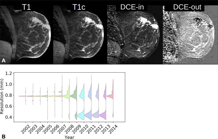 (A) Example of precontrast and first postcontrast fat-saturated images (T1 and T1c, respectively). Initial dynamic contrast enhancement (DCE) in this breast with malignant tumor is evident after subtracting the first T1-weighted contrast-enhanced image from the precontrast image (DCE-in). Subsequent washout (DCE-out) is evident in the subsequent drop in intensity, measured as slope over time. (B) Graph shows the range of in-plane resolutions of T1-weighted contrast-enhanced scans acquired between 2002 and 2014.