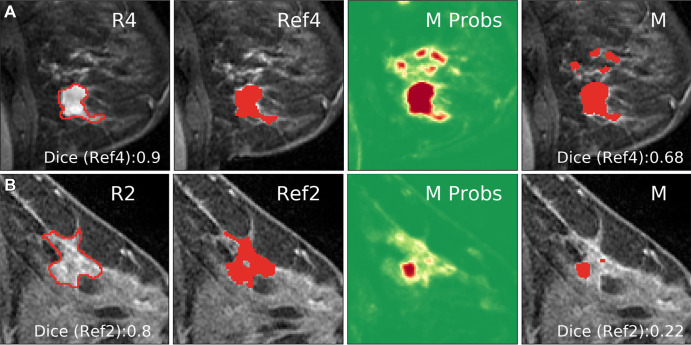 Examples of cases in which the network deviated from the segmentation of the reference radiologist (ref). (A) The network captured additional areas not selected by radiologist 4 (R4). Dice score shown for Ref4 (intersection of R1–R3). (B) The network output (M Probs) captured the correct area, but low probability values yielded a smaller region compared with the consensus segmentation (Ref2) after thresholding.