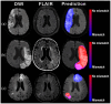 The image shows three cases of brain scans with DWI, FLAIR, and prediction results. In the first case, a patient with a right middle cerebral artery infarct showed no DWI-FLAIR mismatch, matching the ground truth. The second case involved a patient with a left middle cerebral artery infarct, and the FVA-model predicted no DWI-FLAIR mismatch, aligning with the ground truth. Lastly, a patient with bilateral middle cerebral artery infarcts had no DWI-FLAIR mismatch, as predicted by the FVA-model.