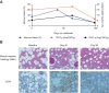 Figure 1. A, Serial bone marrow blasts and mutation burden during molibresib therapy (60-mg QD). There was an initial rise in bone marrow blasts and mutational burden in IDH1 Arg132Cys and TP53 Asp259Tyr during molibresib treatment, but these decreased by day 98. B, Serial bone marrow trephine assessments showing a reduction in blasts by hematoxylin and eosin stain (top) and by CD34 IHC (bottom), as well as evidence of regenerative erythropoiesis at day 98 of molibresib treatment. H&E, hematoxylin and eosin.