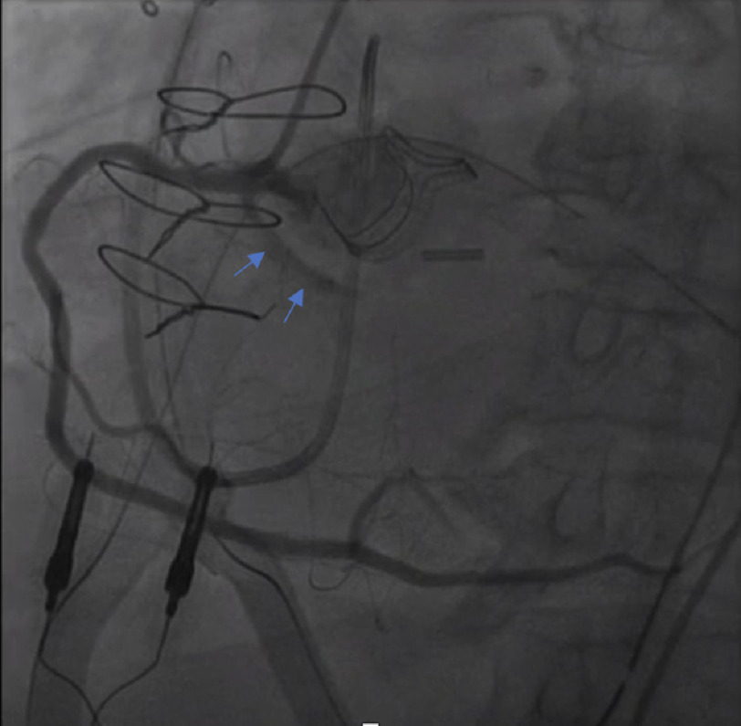 Patent anomalous circumflex coronary artery stent occlusion following ...