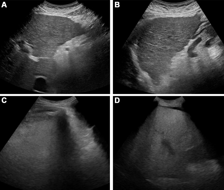 (A, B) Images in a 67-year-old female patient with cirrhosis related to metabolic dysfunction–associated steatotic liver disease who presented for outpatient hepatocellular carcinoma (HCC) surveillance. Grayscale US images through (A) the left lobe in transverse orientation and (B) right lobe in longitudinal orientation show adequate visualization of liver parenchyma without obscuration by attenuation, shadowing structures, or other artifacts. Despite parenchymal coarsening, the examination was scored VIS-A according to the Liver Imaging Reporting and Data System, reflecting a high confidence for excluding HCC (high sensitivity). (C, D) Images in a 41-year-old male patient with alcohol-related decompensated cirrhosis hospitalized for transplant work-up, unable to follow breathing and positioning instructions due to hepatic encephalopathy. Grayscale US images through (C) the left lobe in transverse orientation and (D) right lobe in longitudinal orientation show markedly compromised liver parenchymal visualization due to rib shadowing and excessive parenchymal attenuation, limiting evaluation of the hepatic dome and deeper segments of the right lobe. The examination was scored VIS-C, reflecting the expected decrease in HCC sensitivity.