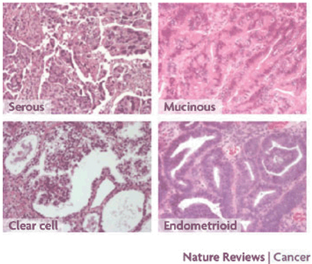 Box 2|Histotypes of epithelial ovarian cancer