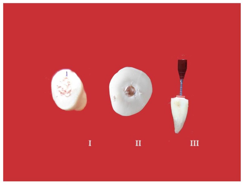 Fig. 15: Obturated Teeth from each Group
GROUPS-I, II & III