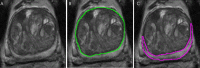 A, Axial T2-weighted section of a prostate with marked benign
prostatic hyperplasia. B, The transition zone is shown in green, while, C,
the peripheral zone is displayed in pink.