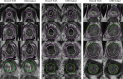Example segmentations in three patients with A, transition zone (TZ)
Dice score of 0.940 and a peripheral zone (PZ) Dice score of 0.902, B, TZ
Dice score of 0.910 and a PZ Dice score of 0.869, and C, TZ Dice score of
0.978 and a PZ Dice score of 0.907. CNN = convolutional neural network.
Green and pink borders indicate TZ and PZ, respectively.