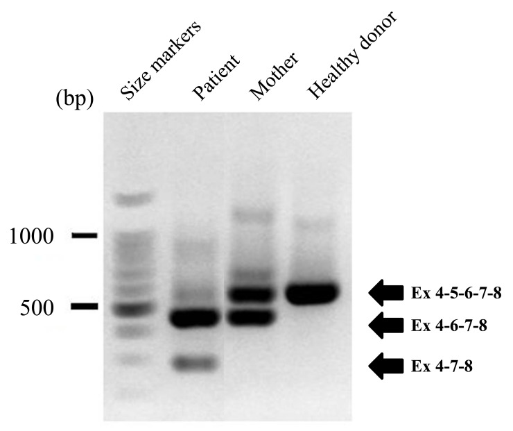 Fig. (5). RNA analysis of neutrophils from a patient with CGD, his mother, and a control subject