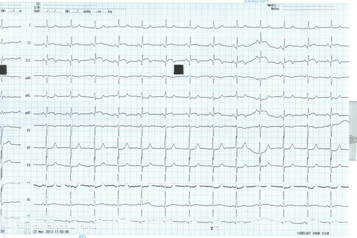 Left arm–left leg lead reversal in a case of inferior wall myocardial ...