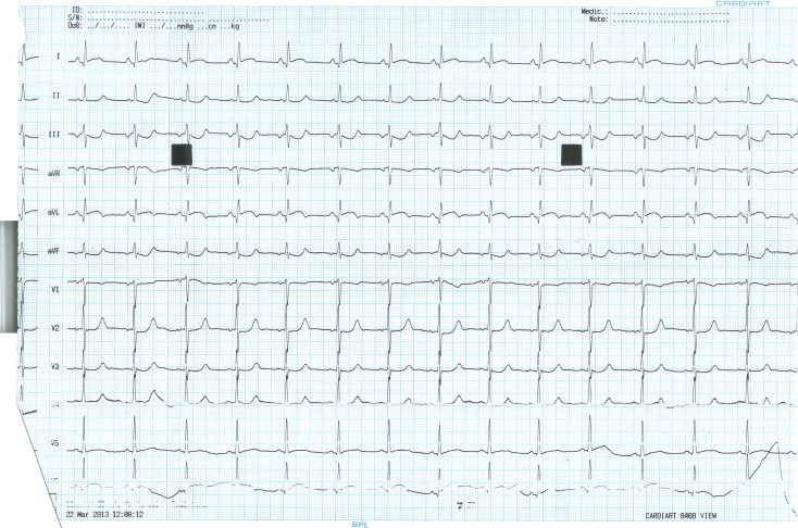 Left arm–left leg lead reversal in a case of inferior wall myocardial ...